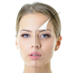 clinic-chemical-peel